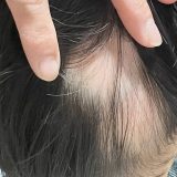 子供の抜け毛専門治療