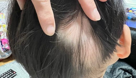 子供の抜け毛が気になったら鍼灸治療をお試しください！ 〜早く、よく効く抜け毛治療〜