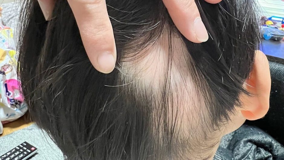 子供の抜け毛専門治療