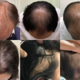 浜松薄毛専門外来
