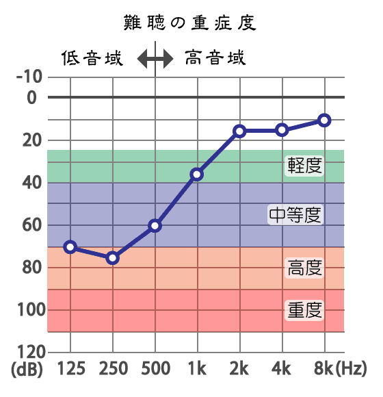 突発性難聴の聴力基準