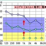 ムンプス難聴