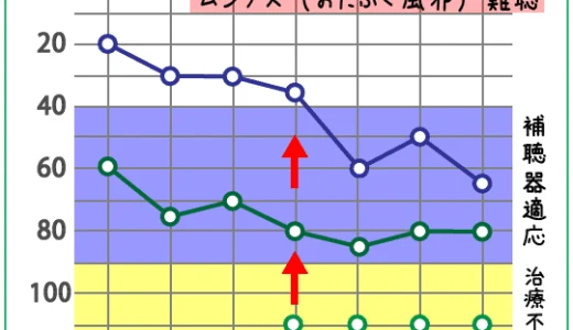 ムンプス難聴