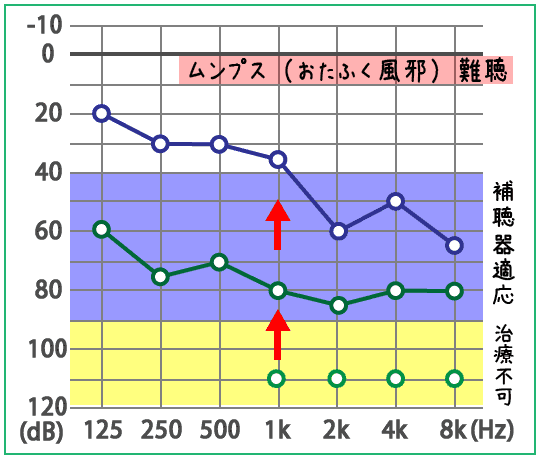 ムンプス難聴