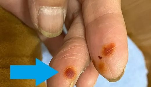 秋から冬になる時期に多い皮膚炎～今年はよく見かけますあなたの指先は大丈夫ですか？～